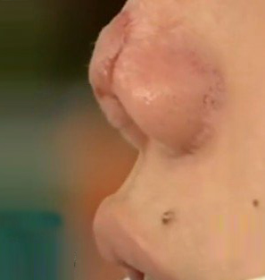 隆鼻失败案例图