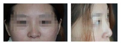 膨体隆鼻失败修复者心声：要高点/自然点