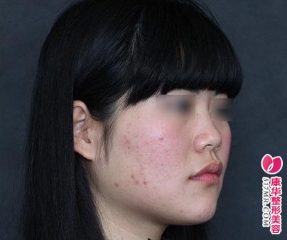 琳琳假体隆鼻术前照片