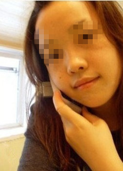 做鼻综合整形前样子