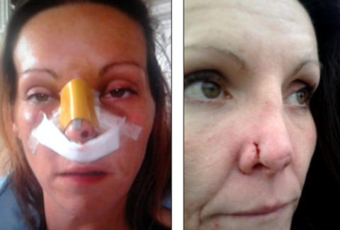 找准医生是有多重要？ 女子鼻整形遇庸医致手术失败