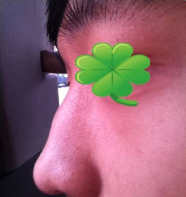 两名鹰钩鼻男子做矫正术