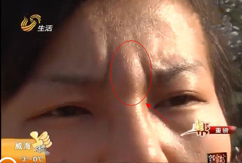 小郑隆鼻后眉心凸起来