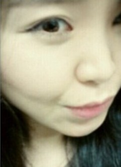 “orpzuyse”隆鼻前样子