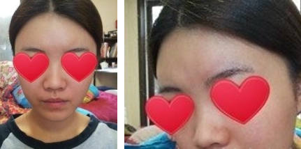 网友嫌塌鼻化妆耗时间 假体隆鼻后变女神