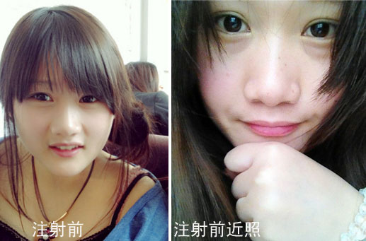 “枣三仨”玻尿酸隆鼻前