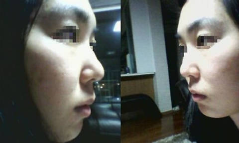 鼻部整形手术前