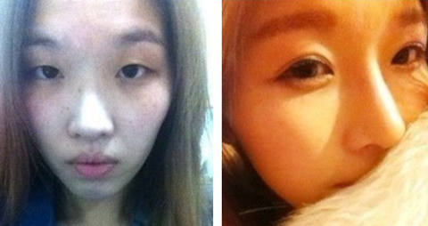 女网友隆鼻体会：想成为女神是如此的简单