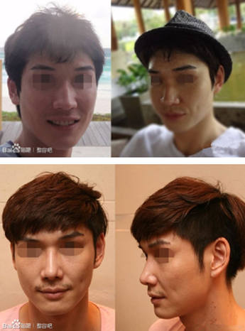 鹰钩鼻男生手术后变型男 坦言找回了信心