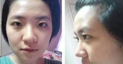 有图有说服力 满意的隆鼻效果秀出来1