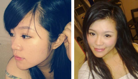 美女分享隆鼻历程 大方上图晒术后效果1