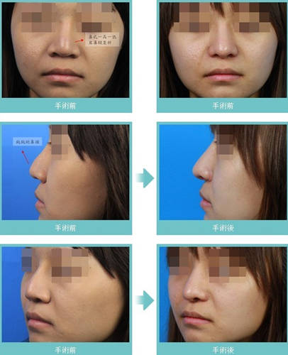 多图：女子二次隆鼻后鼻子变美