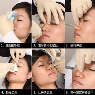 女子体验微整形：注射隆鼻+瘦脸针