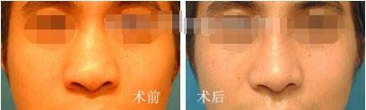 韩式隆鼻手术前后对比一