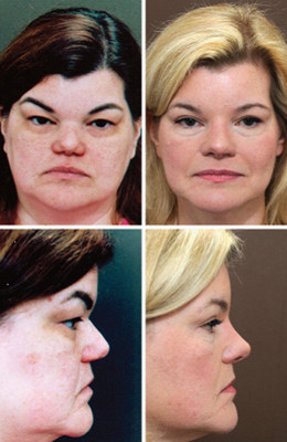 围观求美者做二次鼻部整形对比图