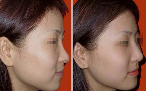 不良鼻形影响找对象？ 塌鼻白领惨遭男友抛弃