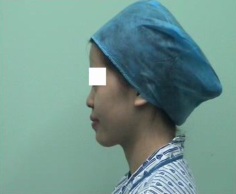 立秀膨体隆鼻前的求美者