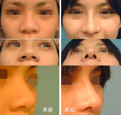 韩式隆鼻前后对比图