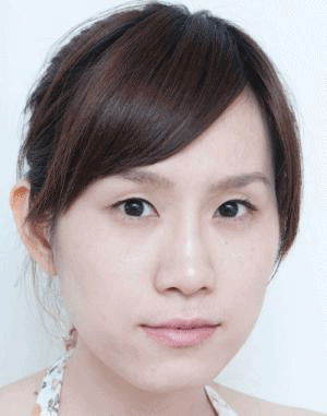 注射玻尿酸前的VIVI