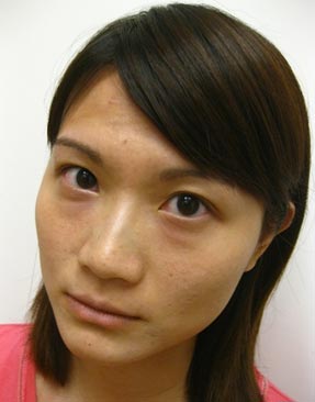 玻尿酸隆鼻前的IVY