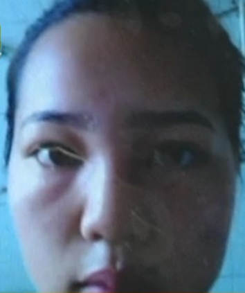 美女隆鼻误入黑诊所 术后“麻烦”接踵而来1