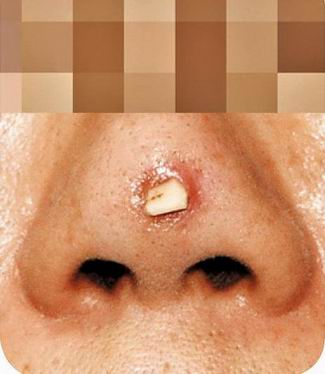 女子假体隆鼻两次皆穿孔