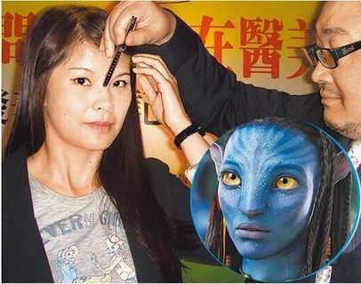 玻尿酸隆鼻位置不对 女子变成阿凡达