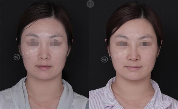 鼻修复案例