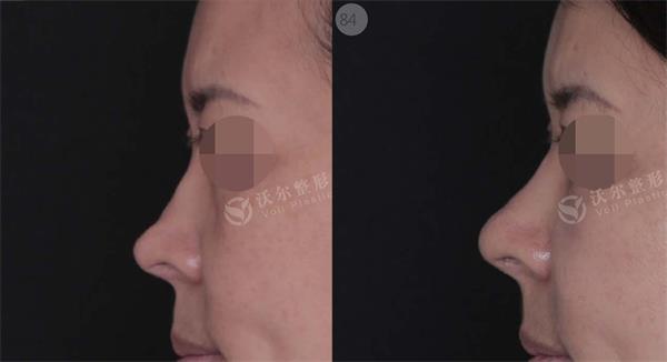 鼻修复案例