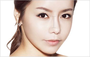 韩式自体软骨隆鼻术 雕塑自然美鼻