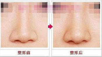 广州做假体隆鼻大概需要多少钱,隆鼻手术,隆鼻手术方案,隆鼻手术是多少钱