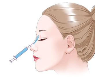 注射隆鼻有永久的吗，注射隆鼻方式，假体隆鼻，注射隆鼻的效果，注射玻尿酸隆鼻