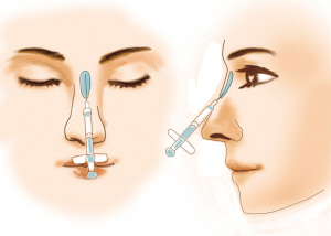 鼻子打玻尿酸副作用，注射玻尿酸垫鼻有哪些副作用呢，