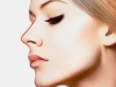 线雕隆鼻多久吸收,线雕面部提升术的优势,线雕隆鼻的维持时间