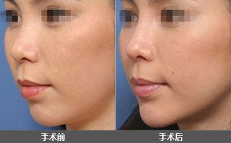  鼻翼肥大有办法矫正吗,有效改善鼻翼肥大,鼻翼皮肤切除术