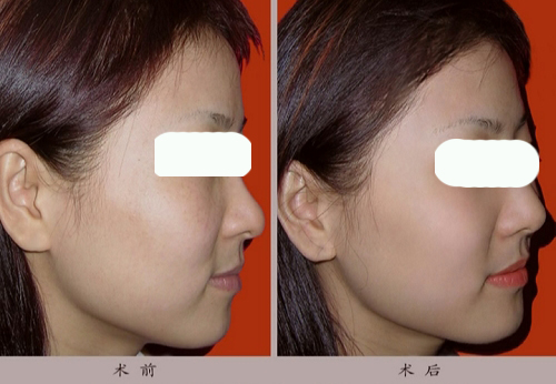 固体硅胶隆鼻,固体硅胶隆鼻术后要注意什么,固体硅胶隆鼻效果真的好吗