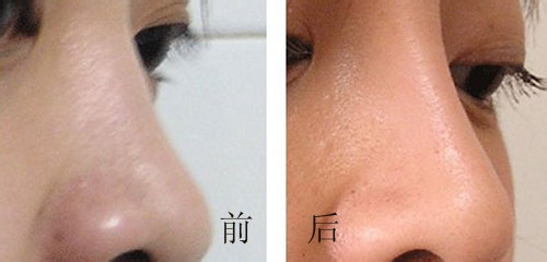 膨体隆鼻价格是多少,膨体隆鼻价格受专家技术的影响