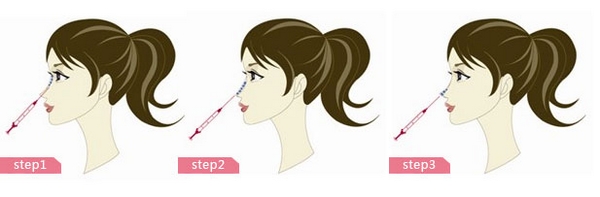 玻尿酸隆鼻整形,玻尿酸注射隆鼻,玻尿酸注射隆鼻