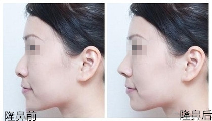 硅胶隆鼻整形术