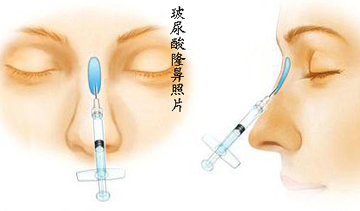 玻尿酸注射隆鼻术