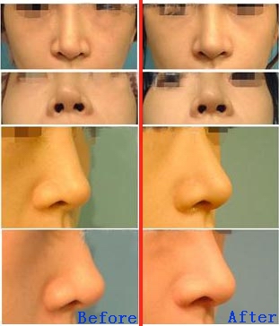 小惠二次隆鼻手术前后对比图