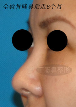 王艇鼻修复案例:修复短小的膨体隆鼻
