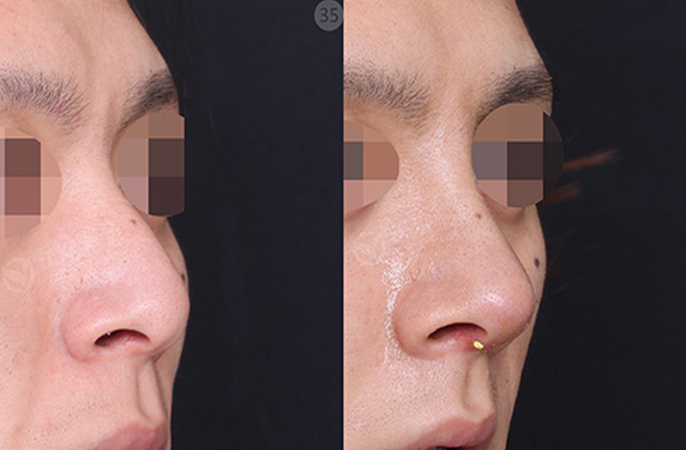 鼻修复案例