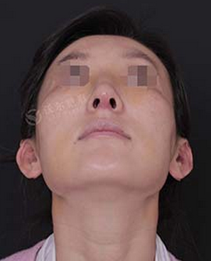 刘彦军鼻修复案例:硅胶隆鼻取出